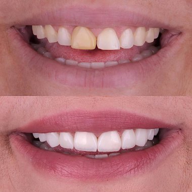 Diş hekimliğinde estetik gülümseme tasarımı tedavisi. Kaplamalı diş tedavisi, diş implantları ve porselen kaplamalar. Gülümse makyaj ve diş bakımı öncesi ve sonrası. 
