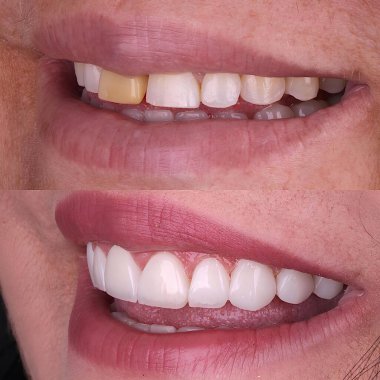 Diş hekimliğinde estetik gülümseme tasarımı tedavisi. Kaplamalı diş tedavisi, diş implantları ve porselen kaplamalar. Gülümse makyaj ve diş bakımı öncesi ve sonrası. 