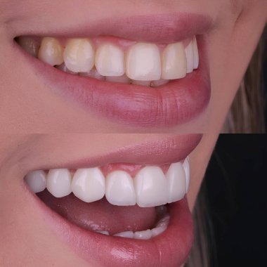 Diş hekimliğinde estetik gülümseme tasarımı tedavisi. Kaplamalı diş tedavisi, diş implantları ve porselen kaplamalar. Gülümse makyaj ve diş bakımı öncesi ve sonrası. 