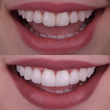 Diş hekimliğinde estetik gülümseme tasarımı tedavisi. Kaplamalı diş tedavisi, diş implantları ve porselen kaplamalar. Gülümse makyaj ve diş bakımı öncesi ve sonrası. 