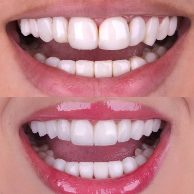 Diş hekimliğinde estetik gülümseme tasarımı tedavisi. Kaplamalı diş tedavisi, diş implantları ve porselen kaplamalar. Gülümse makyaj ve diş bakımı öncesi ve sonrası. 
