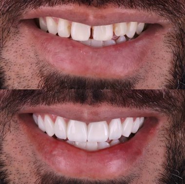 Diş hekimliğinde estetik gülümseme tasarımı tedavisi. Kaplamalı diş tedavisi, diş implantları ve porselen kaplamalar. Gülümse makyaj ve diş bakımı öncesi ve sonrası. 