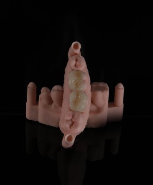 Porselen dolgu, E-Max ve zirkonyum porselen kullanarak bilgisayar destekli diş hekimliğinde tasarlandı. Dijital çene modeliyle porselen doluyor. Estetik dişçilik. Gülümse..