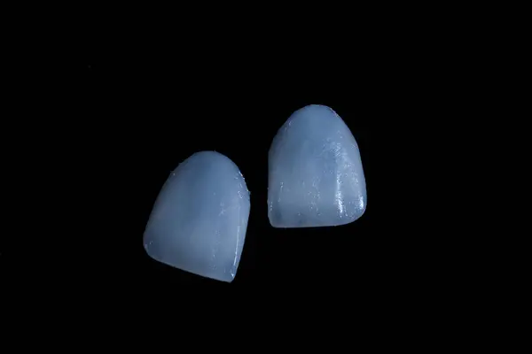 Diş porseleni kaplamalar. Diş hekimliğinde, gülümseme tasarımı tedavisinde diş macunu kaplaması. Gülümse makyaj..