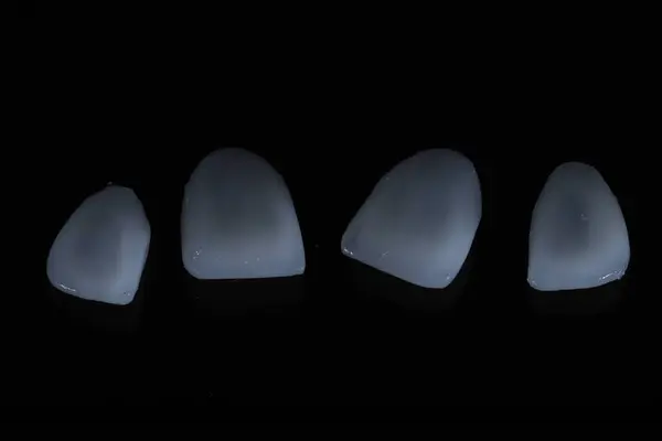 Diş porseleni kaplamalar. Diş hekimliğinde, gülümseme tasarımı tedavisinde diş macunu kaplaması. Gülümse makyaj..