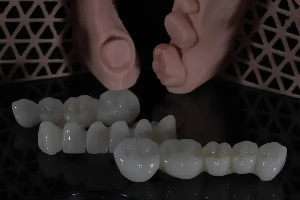 Dolgun ağızlı protez porselen kaplamalar zirkonyum malzemesinden yapılmış. Dişçi gülümseme tasarımı ve bilgisayar destekli çene modeli.