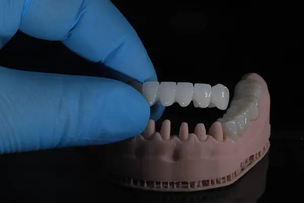 Dolgun ağızlı protez porselen kaplamalar zirkonyum malzemesinden yapılmış. Dişçi gülümseme tasarımı ve bilgisayar destekli çene modeli.