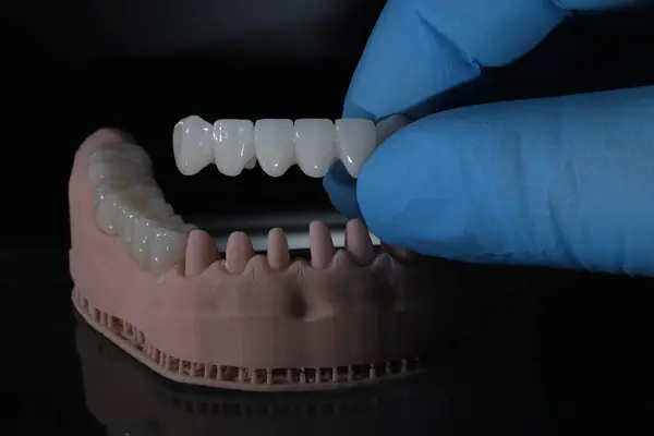 Dolgun ağızlı protez porselen kaplamalar zirkonyum malzemesinden yapılmış. Dişçi gülümseme tasarımı ve bilgisayar destekli çene modeli.