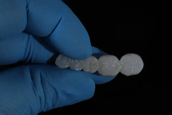 Dolgun ağızlı protez porselen kaplamalar zirkonyum malzemesinden yapılmış. Dişçi gülümseme tasarımı ve bilgisayar destekli çene modeli.