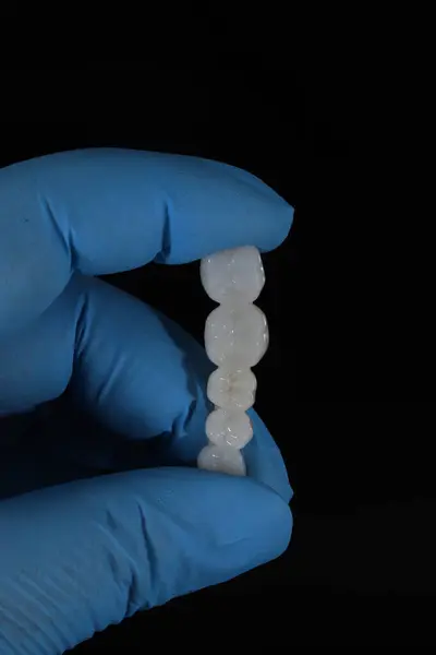 Dolgun ağızlı protez porselen kaplamalar zirkonyum malzemesinden yapılmış. Dişçi gülümseme tasarımı ve bilgisayar destekli çene modeli.