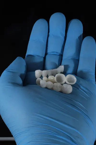 Dolgun ağızlı protez porselen kaplamalar zirkonyum malzemesinden yapılmış. Dişçi gülümseme tasarımı ve bilgisayar destekli çene modeli.