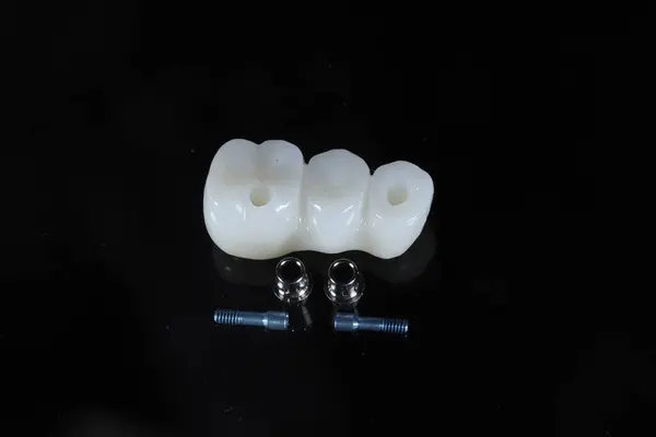 Diş ve kozmetik dişçiliğinde, porselen köprü protezleri ve implant vidaları ile kemik çeperli diş implantı tedavisi.