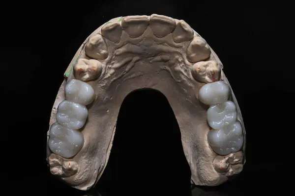 Diş estetik cerrahisinde, cam-seramik porselen E-max ve zirkonyum porselen diş kaplamalarıyla gülümseme tasarımı. Gülümseyin ve kaplamaları kaplayın. dijital dişçilik