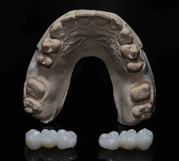 Diş ve kozmetik dişçiliğinde porselen kaplama. Zirkon ve E-max lamine kaplamalar. Gülümse, makyaj dişleri önce ve sonra.