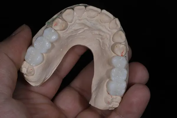 Diş köprüsü kaplaması, damar içi alçı üzerinde tasarlanmış. Zirkonyumdan yapılmış diş köprüleri estetik bir görünüme sahiptir..