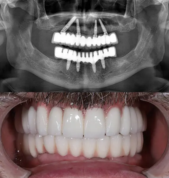 Diş hekimliği yapan tamamen kendi halinde bir kadın hasta için implantlar üzerine tam kemerli diş protezi. Öncesinde ve sonrasında porselen diş protezi.