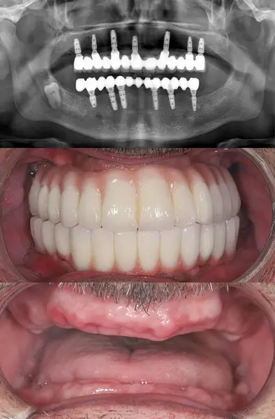 Diş hekimliğinde, diş implantı tedavisi 4 implanta tam kemerli diş protezi takmayı içerir. İşlem, diş öncesi ve sonrası görüntülerini ve röntgen görüntülerini içeriyor. Gülümse..