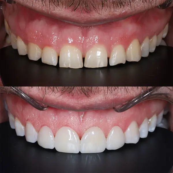 Rengi atmış, kırılmış ve yıpranmış dişlerin E-maksimum ve zirkonyum kaplamalı kozmetik dişçilikte yenilenmesi. Diş tedavisinden önce ve sonra ve gülümseme tasarım terapisini içerir.