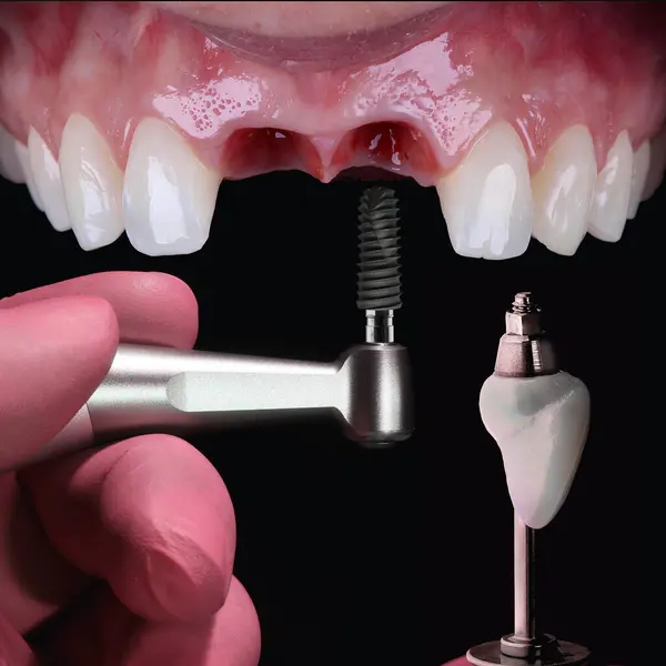 Diş implantı tedavisinde estetik bölgedeki ön dişlerin restorasyonu implantlarda E-max veya zirkon porselenleri kullanılarak yapılır. Süreç, diş öncesi ve sonrası resimlerini içerir.
