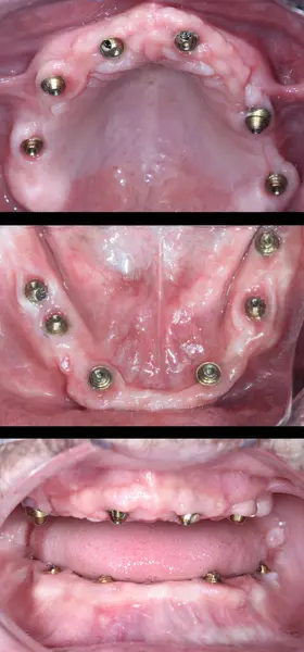 Diş implantı ameliyatı sırasında tam kemerli diş protezleri. Diş hekimliğinde diş tedavisi. Öncesinde ve sonrasında diş hekimi. Gülümse makyaj..