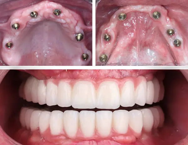Diş hekimliğinde, diş implantı tedavisiyle çene tam kemerli diş protezi. Gülümsemeden önce ve sonra diş bakımı. Protez destekli diş tacı.