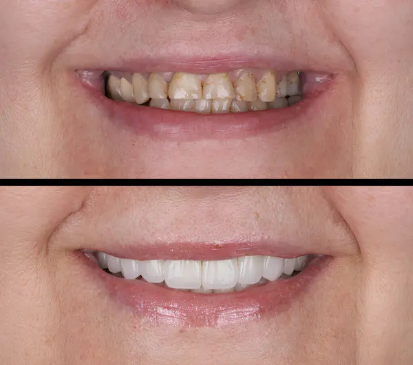 Diş hekimliğinde, diş implantı tedavisiyle çene tam kemerli diş protezi. Gülümsemeden önce ve sonra diş bakımı. Protez destekli diş tacı.