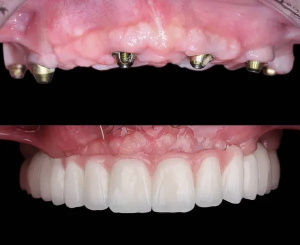 Diş hekimliğinde, diş implantı tedavisiyle çene tam kemerli diş protezi. Gülümsemeden önce ve sonra diş bakımı. Protez destekli diş tacı.