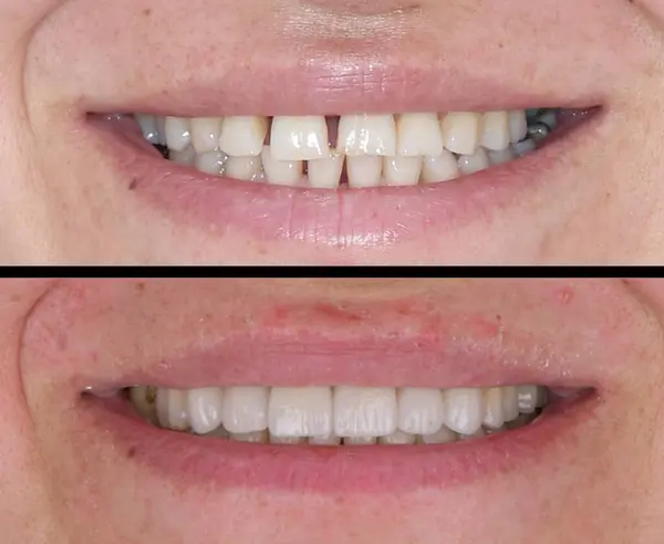 Diş hekimliğinde estetik gülümseme tasarımı tedavisi. Kaplamalı diş tedavisi, diş implantları ve porselen kaplamalar. Gülümse makyaj ve diş bakımı öncesi ve sonrası. 