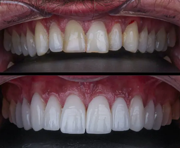 Diş hekimliğinde estetik gülümseme tasarımı tedavisi. Kaplamalı diş tedavisi, diş implantları ve porselen kaplamalar. Gülümse makyaj ve diş bakımı öncesi ve sonrası. 