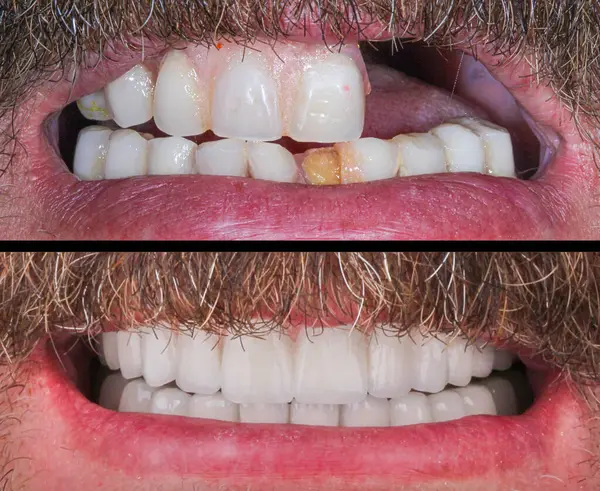 Diş hekimliğindeki çene dokusunda implant ameliyatı uygulanır. Çene implantı tedavisi. Adı 