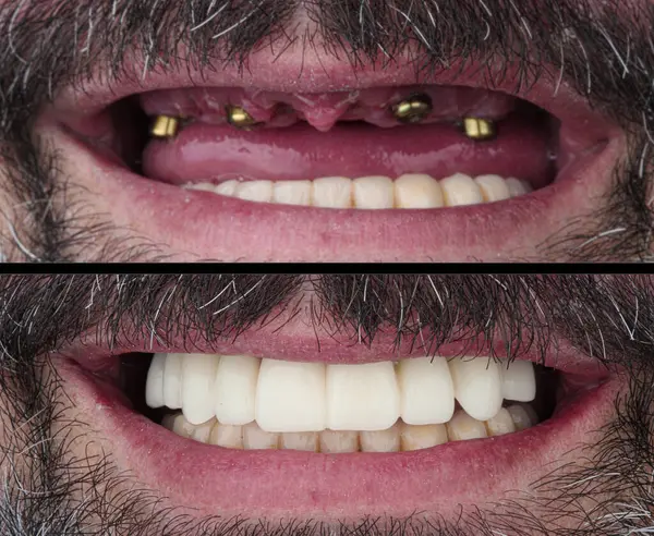 Diş hekimliğindeki çene dokusunda implant ameliyatı uygulanır. Çene implantı tedavisi. Adı 