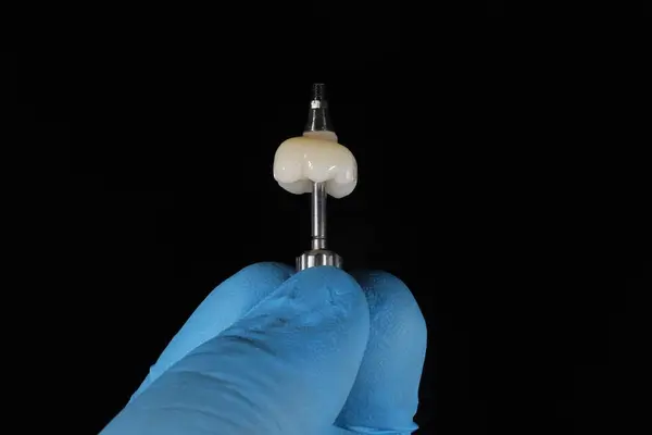 Porselen E-Max ya da zirkonyum protez tedavisi, diş cerrahisi yoluyla kemik yerleştirilmiş diş implantları tarafından destekleniyor. Gülümse tasarım tedavisi ve gülümseme makyajı.