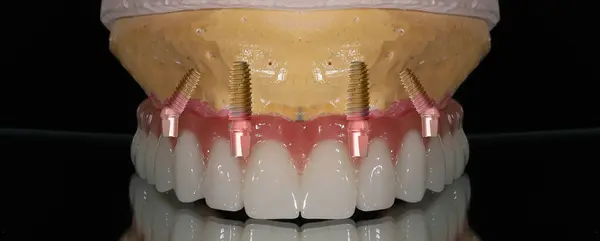Diş cerrahisi sırasında kemik nakli ve diş implantı uygulanmış. Diş implantı anahtarıyla vidalanmış diş protezi. Gülümse, baştan yarat, tek başına