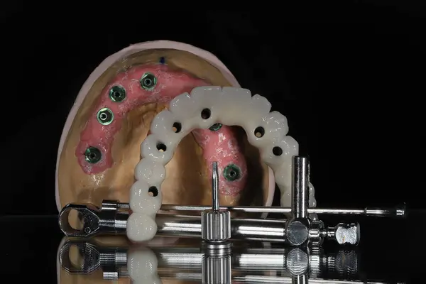 Mavi eldiven takan bir dişçinin tam kemerli diş protezi. İmplant destekli porselen, tam kemerli diş protezi. Vidalı implant diş protezi. Gülümse tasarımı.