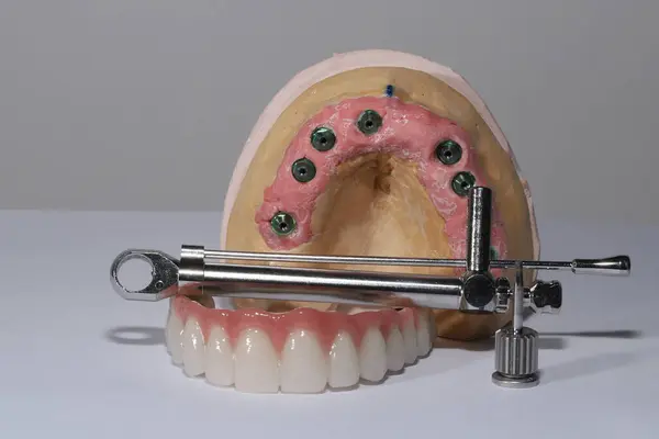 Mavi eldiven takan bir dişçinin tam kemerli diş protezi. İmplant destekli porselen, tam kemerli diş protezi. Vidalı implant diş protezi. Gülümse tasarımı.