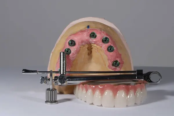 Mavi eldiven takan bir dişçinin tam kemerli diş protezi. İmplant destekli porselen, tam kemerli diş protezi. Vidalı implant diş protezi. Gülümse tasarımı.