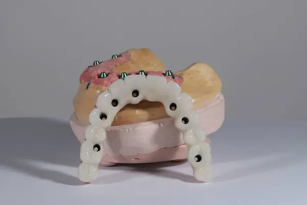 Mavi eldiven takan bir dişçinin tam kemerli diş protezi. İmplant destekli porselen, tam kemerli diş protezi. Vidalı implant diş protezi. Gülümse tasarımı.