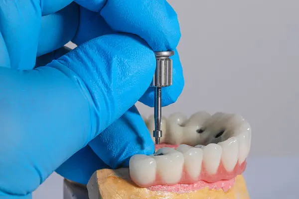 Mavi eldiven takan bir dişçinin tam kemerli diş protezi. İmplant destekli porselen, tam kemerli diş protezi. Vidalı implant diş protezi. Gülümse tasarımı.