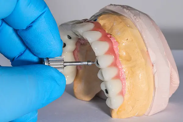 Mavi eldiven takan bir dişçinin tam kemerli diş protezi. İmplant destekli porselen, tam kemerli diş protezi. Vidalı implant diş protezi. Gülümse tasarımı.