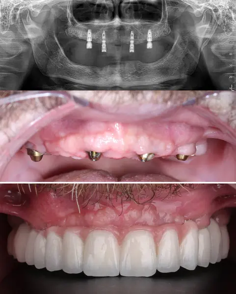 Mavi eldiven takan bir dişçinin tam kemerli diş protezi. İmplant destekli porselen, tam kemerli diş protezi. Vidalı implant diş protezi. Gülümse tasarımı.