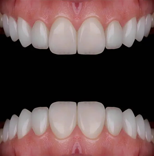 Mavi eldiven takan bir dişçinin tam kemerli diş protezi. İmplant destekli porselen, tam kemerli diş protezi. Vidalı implant diş protezi. Gülümse tasarımı.