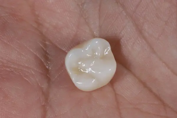 Mavi eldiven takan bir dişçinin tam kemerli diş protezi. İmplant destekli porselen, tam kemerli diş protezi. Vidalı implant diş protezi. Gülümse tasarımı.