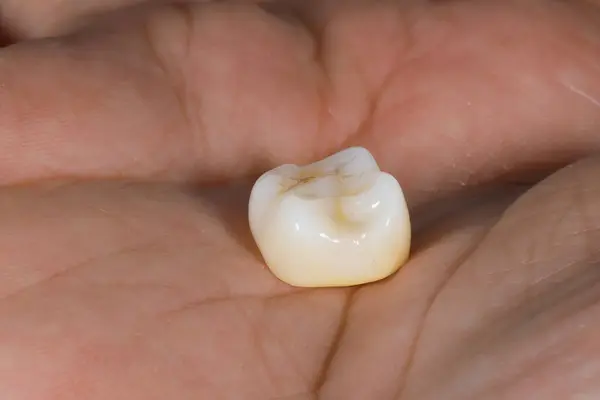 Mavi eldiven takan bir dişçinin tam kemerli diş protezi. İmplant destekli porselen, tam kemerli diş protezi. Vidalı implant diş protezi. Gülümse tasarımı.