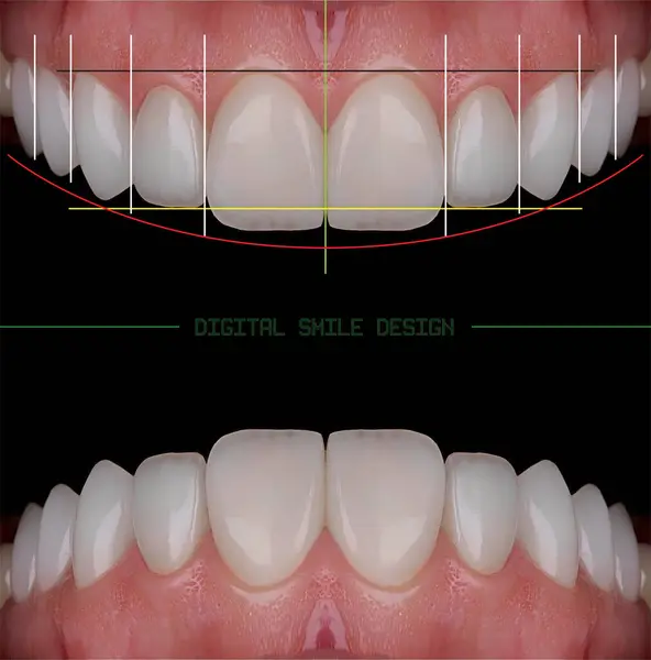 Mavi eldiven takan bir dişçinin tam kemerli diş protezi. İmplant destekli porselen, tam kemerli diş protezi. Vidalı implant diş protezi. Gülümse tasarımı.