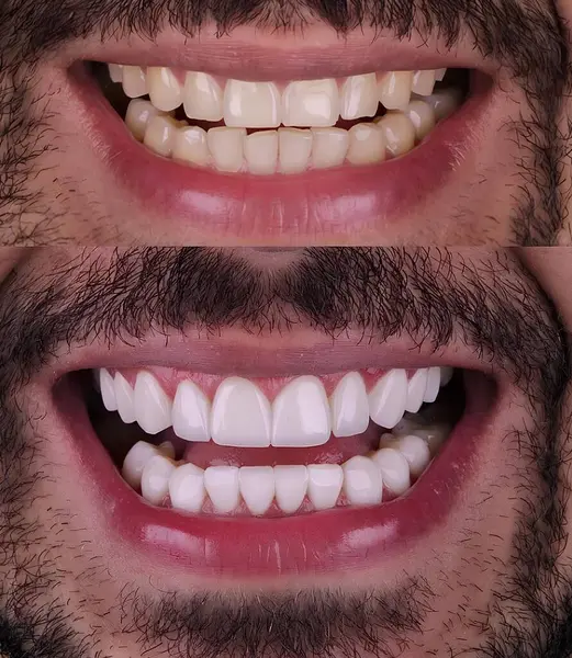 Diş hekimliğinde estetik gülümseme tasarımı tedavisi. Kaplamalı diş tedavisi, diş implantları ve porselen kaplamalar. Gülümse makyaj ve diş bakımı öncesi ve sonrası. 