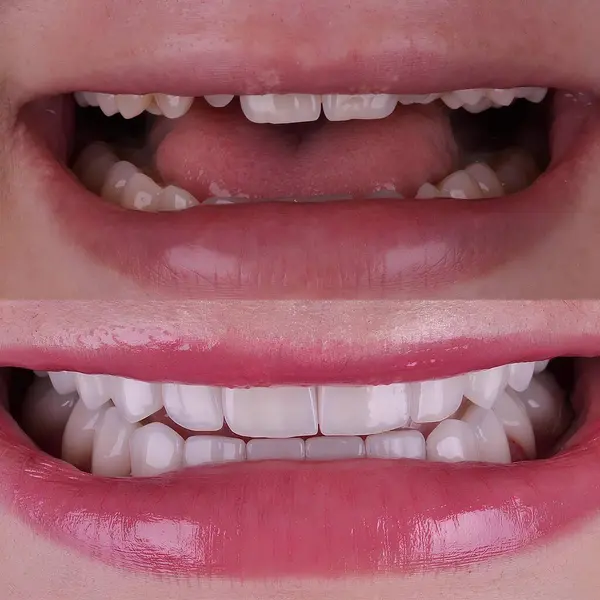 Diş hekimliğinde estetik gülümseme tasarımı tedavisi. Kaplamalı diş tedavisi, diş implantları ve porselen kaplamalar. Gülümse makyaj ve diş bakımı öncesi ve sonrası. 