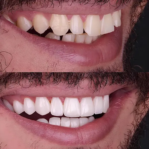 Diş hekimliğinde estetik gülümseme tasarımı tedavisi. Kaplamalı diş tedavisi, diş implantları ve porselen kaplamalar. Gülümse makyaj ve diş bakımı öncesi ve sonrası. 
