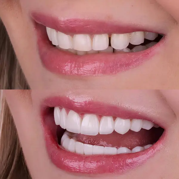 Diş hekimliğinde estetik gülümseme tasarımı tedavisi. Kaplamalı diş tedavisi, diş implantları ve porselen kaplamalar. Gülümse makyaj ve diş bakımı öncesi ve sonrası. 