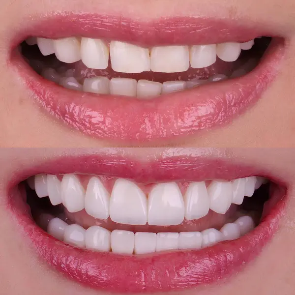Diş hekimliğinde estetik gülümseme tasarımı tedavisi. Kaplamalı diş tedavisi, diş implantları ve porselen kaplamalar. Gülümse makyaj ve diş bakımı öncesi ve sonrası. 