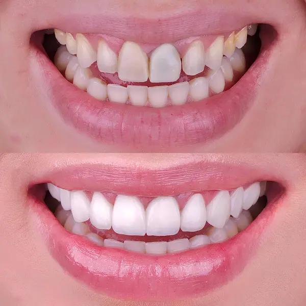 Diş hekimliğinde estetik gülümseme tasarımı tedavisi. Kaplamalı diş tedavisi, diş implantları ve porselen kaplamalar. Gülümse makyaj ve diş bakımı öncesi ve sonrası. 